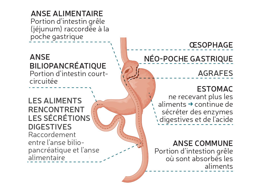 bypass-département de chirurgie digestive CHU Toulouse